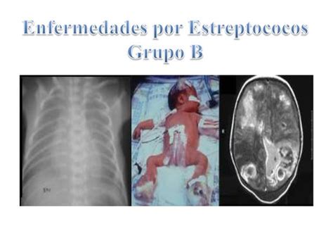 group beta strep|Enfermedad causada por el estreptococo del grupo B.